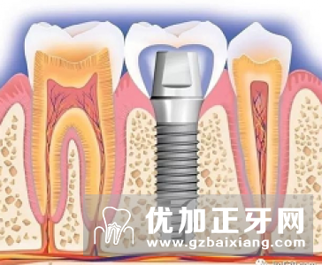 牙齿缺失了，三种修复手段，哪种会比较好？