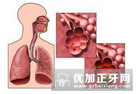 肺气肿的症状