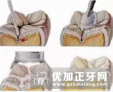 给宝宝做窝沟封闭的4个最佳时机，你错过了吗？