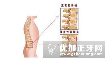 葡萄膜炎的病因